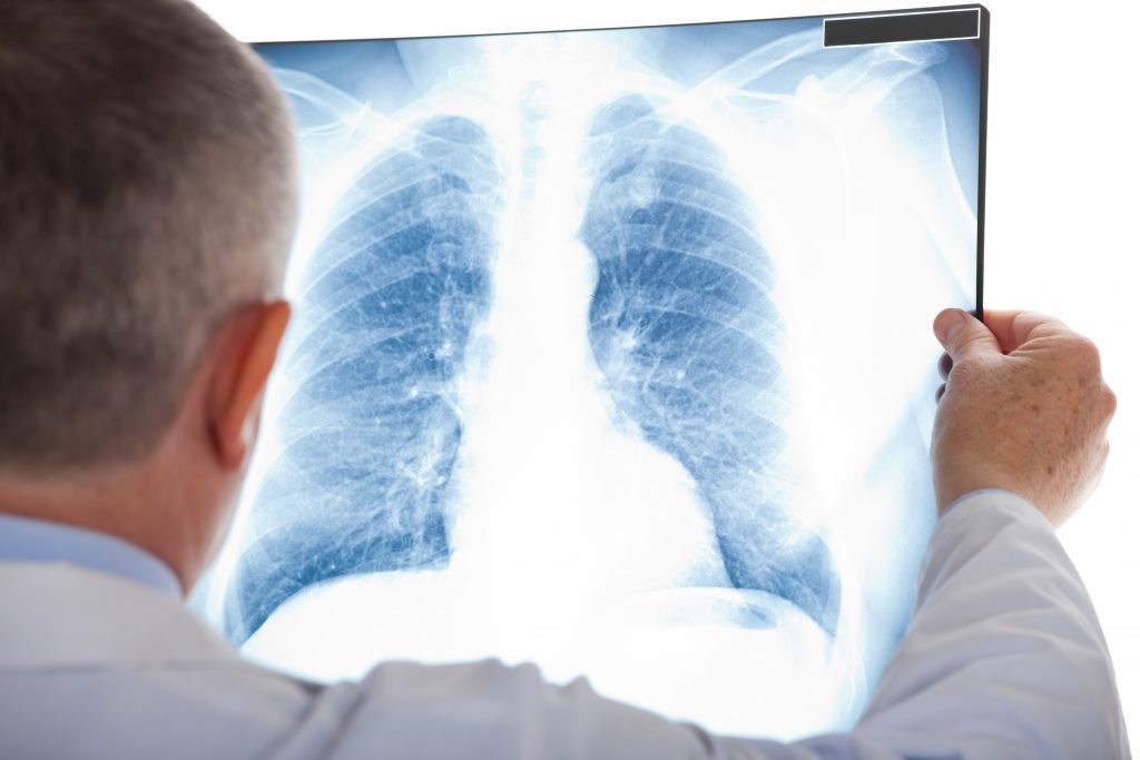 Depositphotos_30135963_original Asbestos damage x-ray xray.