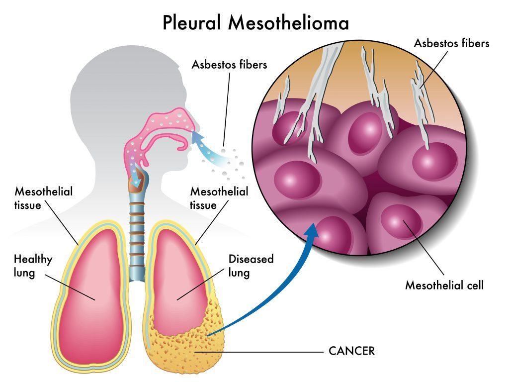 pleural mesothelioma Asbestos damaged internal organs.